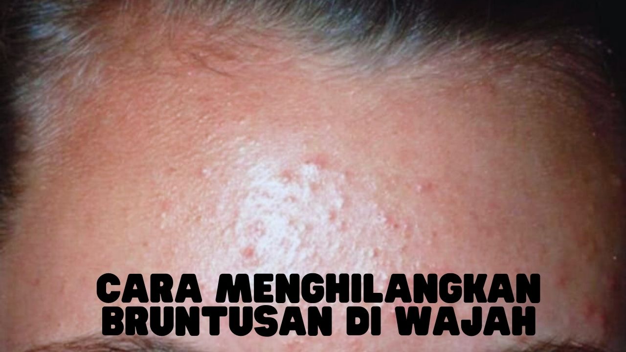 Cara Menghilangkan Bruntusan di Wajah